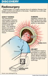 Gamma Knife Surgery Radiosurgery Illustration